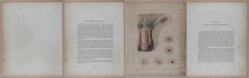 E345 - Illustrations of Syphilitic - i11859-11860-11861