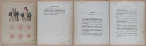 E345 - Illustrations of Syphilitic - i11870-11871-11872-11873