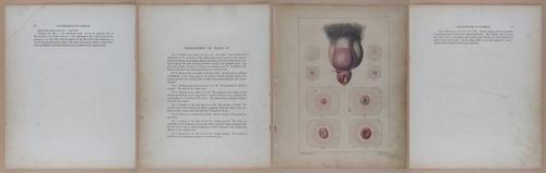 E345 - Illustrations of Syphilitic - i11874-11875-11876-11877