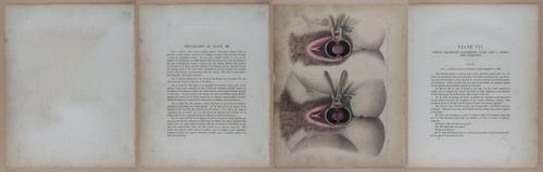 E345 - Illustrations of Syphilitic - i11889-11890-11891