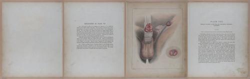 E345 - Illustrations of Syphilitic - i11897-11898-11899