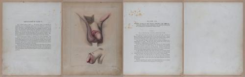E345 - Illustrations of Syphilitic - i11926-11927-11928