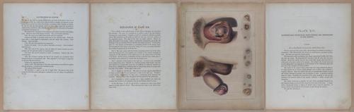 E345 - Illustrations of Syphilitic - i11949-11950-11951-11952