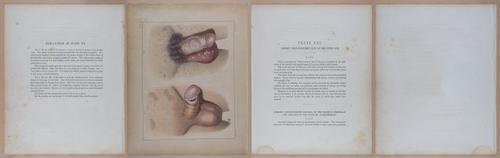 E345 - Illustrations of Syphilitic - i11997-11998-11999