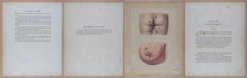 E345 - Illustrations of Syphilitic - i12020-12021-12022-12023