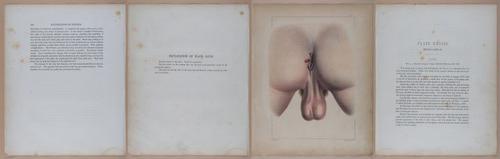E345 - Illustrations of Syphilitic - i12037-12038-12039-12040