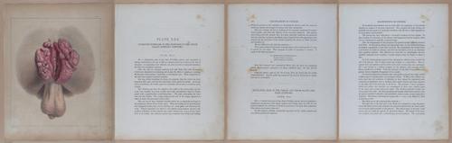 E345 - Illustrations of Syphilitic - i12049-12050-12051-12052