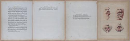 E345 - Illustrations of Syphilitic - i12062-12063-12064-12065