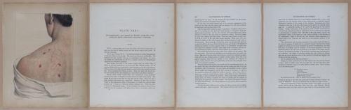 E345 - Illustrations of Syphilitic - i12081-12082-12083-12084