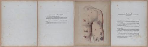 E345 - Illustrations of Syphilitic - i12098-12099-12100