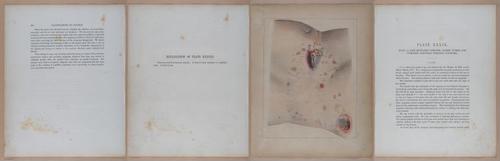 E345 - Illustrations of Syphilitic - i12101-12102-12103-12104