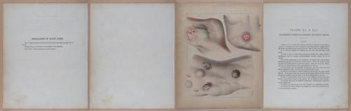 E345 - Illustrations of Syphilitic - i12109-12110-12111