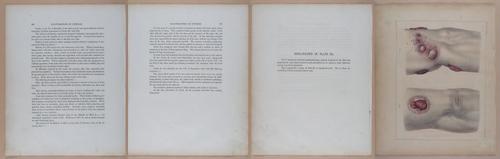 E345 - Illustrations of Syphilitic - i12112-12113-12114-12115