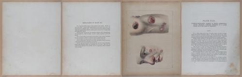 E345 - Illustrations of Syphilitic - i12116-12117-12119