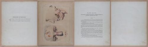 E345 - Illustrations of Syphilitic - i12146-12147-12148